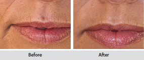 juvederm dermal filler