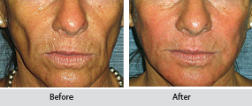 radiesse dermal filler