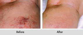 sclerotherapy - thread vein removal